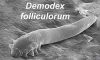 Demodex Mites’ Role in Chronic Dry Eye Issues