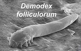 Demodex Mites’ Role in Chronic Dry Eye Issues