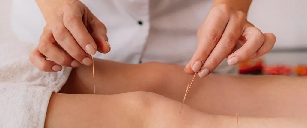 Acupuncture for Stress Relief and Anxiety Management Guide
