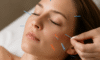 Cosmetic Acupuncture: Important Drawbacks to Know